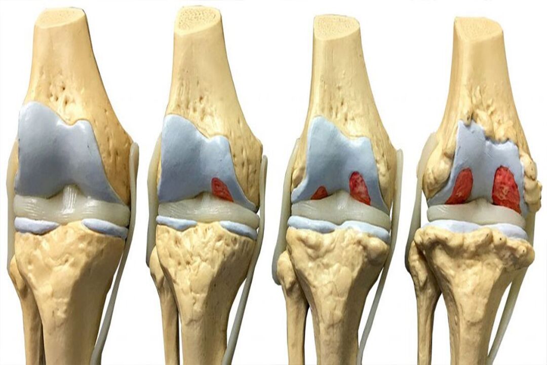 Stages of the development of arthrosis