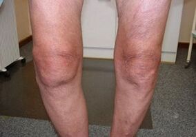 How to treat the knee joint arthrosis