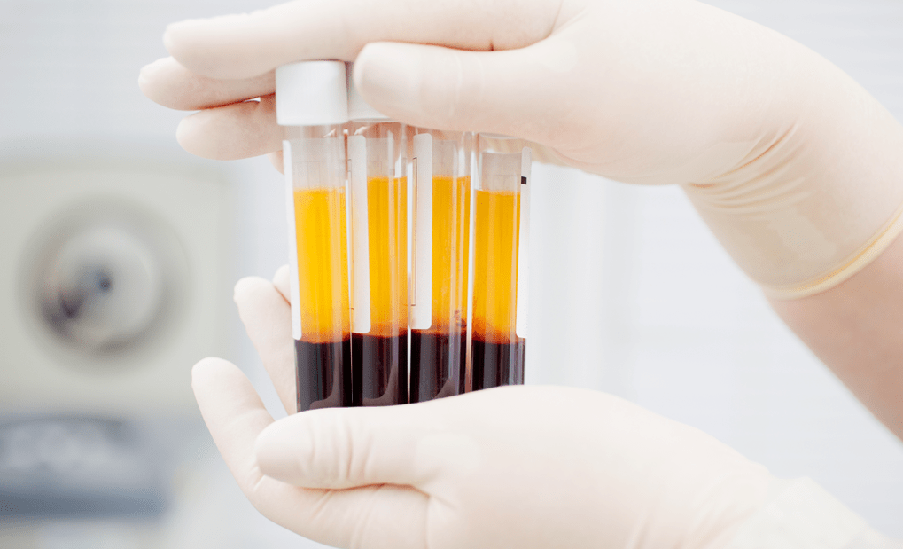 Platelet-rich plasma for PRP therapy of arthrosis